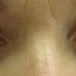 Che cos'è il glaucoma e come curarlo?