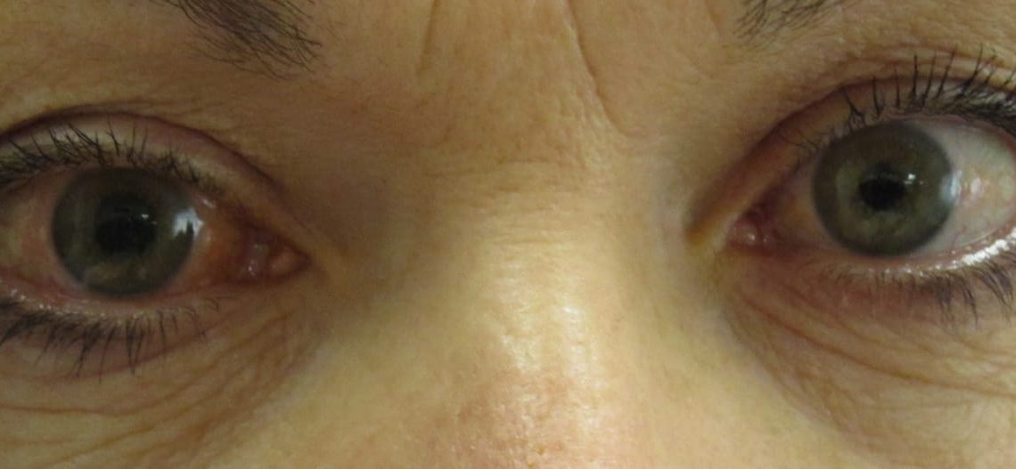 Che cos’è il glaucoma e come curarlo?